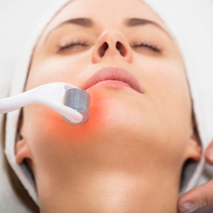 Curso Livre em  Microagulhamento – Facial e Corporal com Ênfase Prática